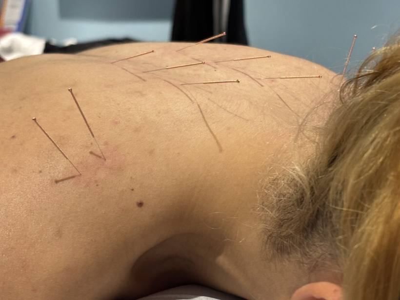 Medical Acupuncture (Dry Needling) at Milton Keynes Sports Therapy